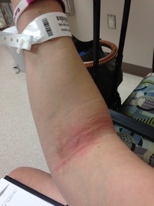 Battle Wound from IV / Blood work, Labs and Scans